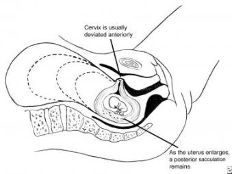 Uterine retroversion and incarceration (Malposition of the Uterus - Medscape)